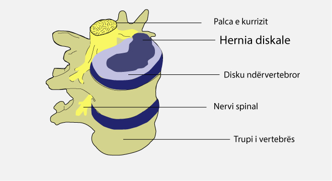 Hernia diskale: ndryshime degjenerative në disqet ndërvertebrale.