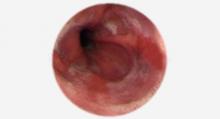 Sëmundja e refluksit: gastroskopia tregon inflamacion të ezofagut.