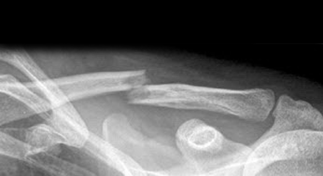 Thyerja e klavikulës: radiografia.